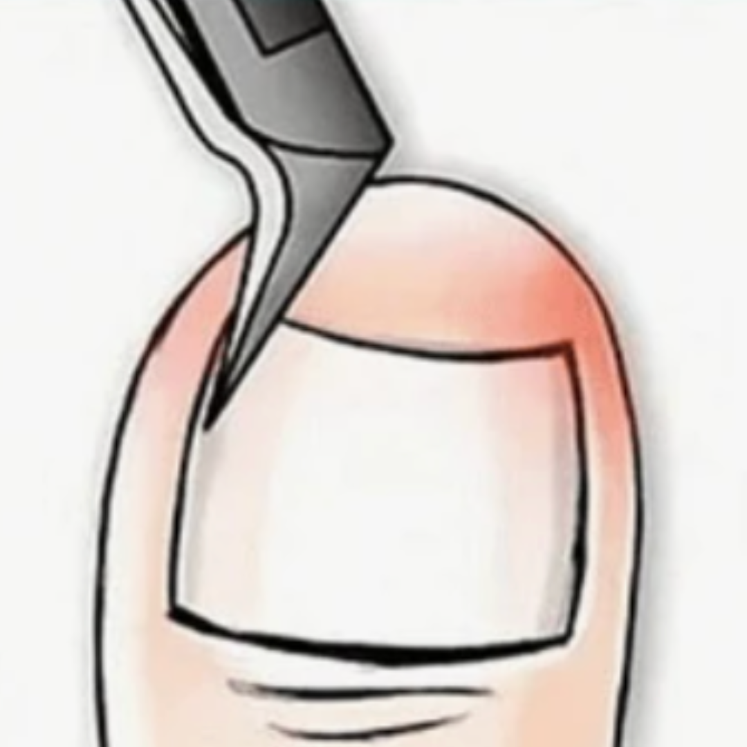 Coupe-ongles incarnés